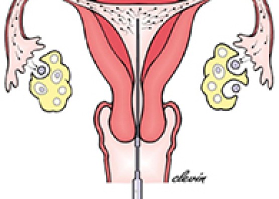 27. IUI